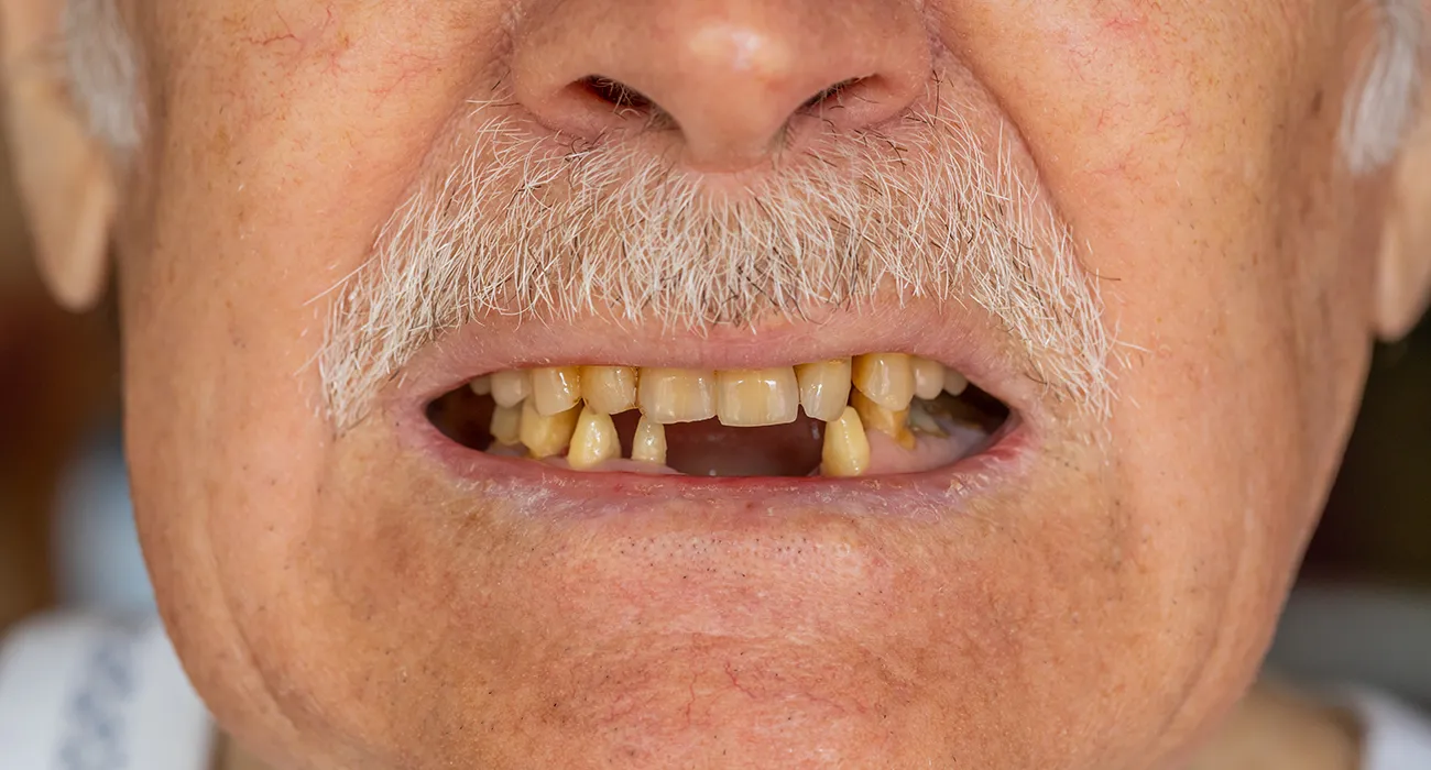older man showing missing teeth