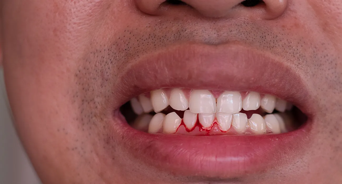 Man experiencing bleeding gums