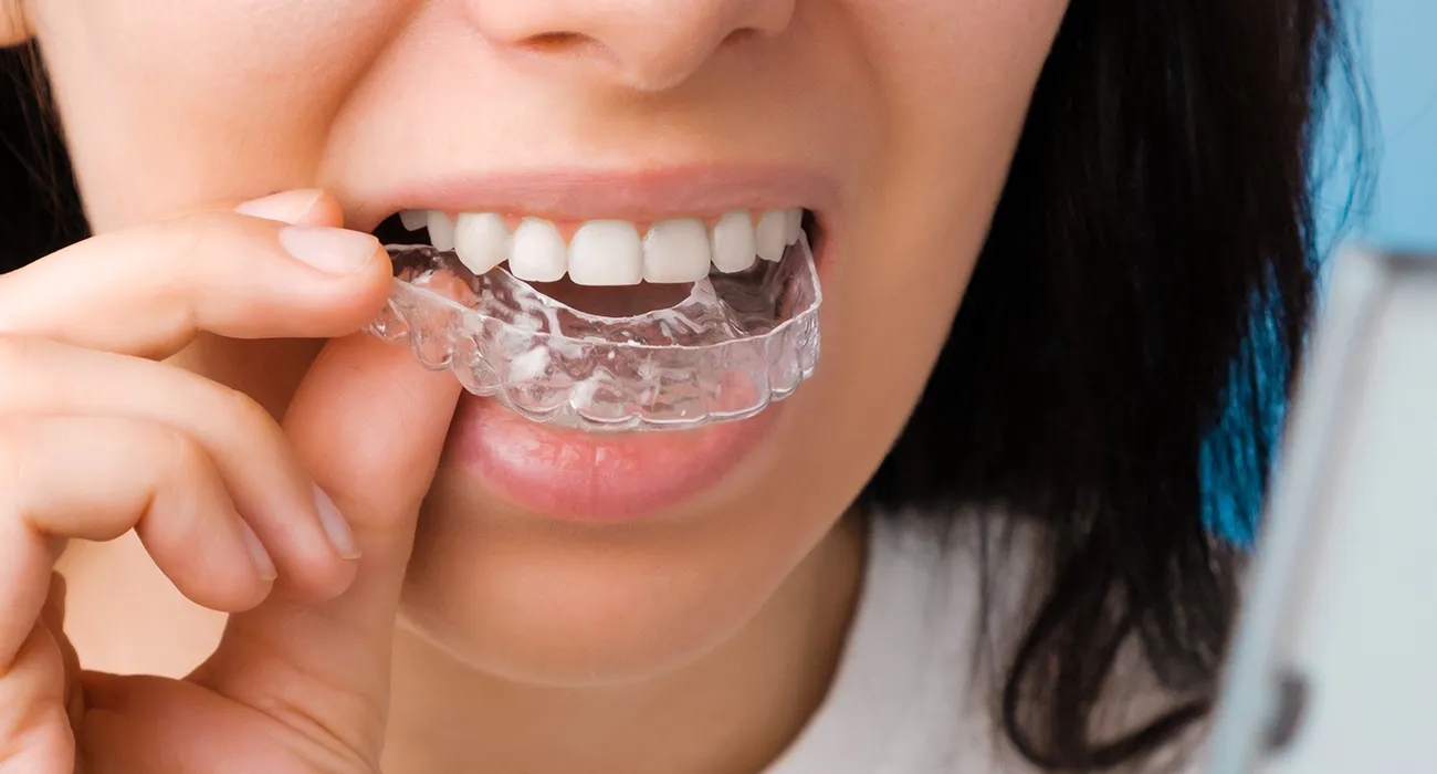 Woman fitting a clear aligner tray properly